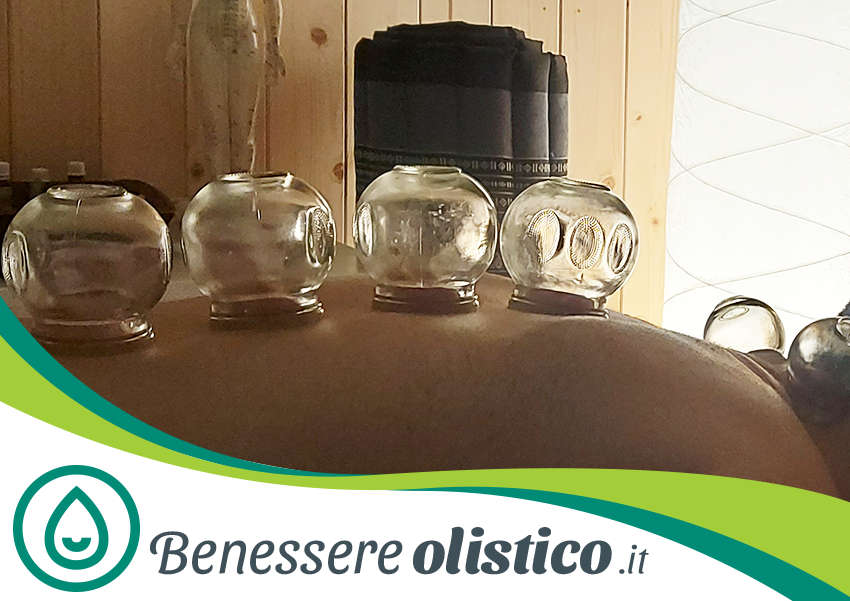 Coppettazione