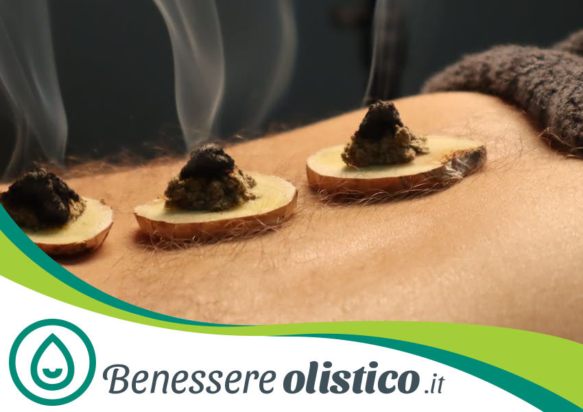 Coni di moxa su punti dei Meridiani