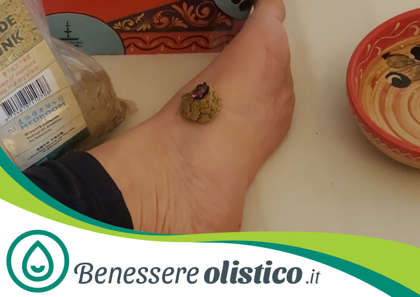 Coni di moxa su punti dei Meridiani